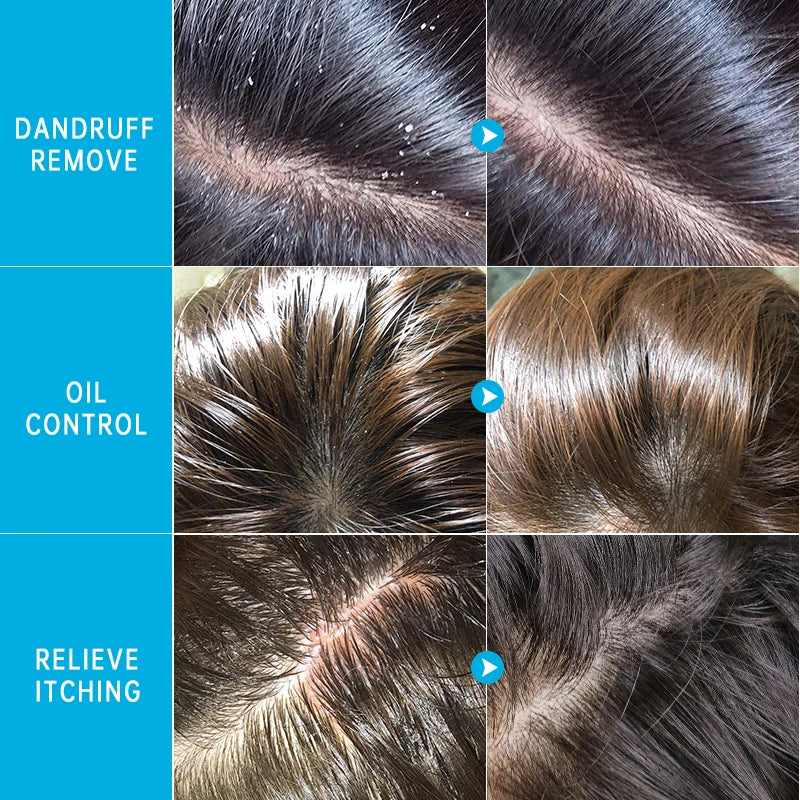 Fast Anti Exfoliating Scrub Remove Dandruff Anti Itching Treatment Seborrheic Scalp Oil Control Cleansing Repair Scalp Care 50g