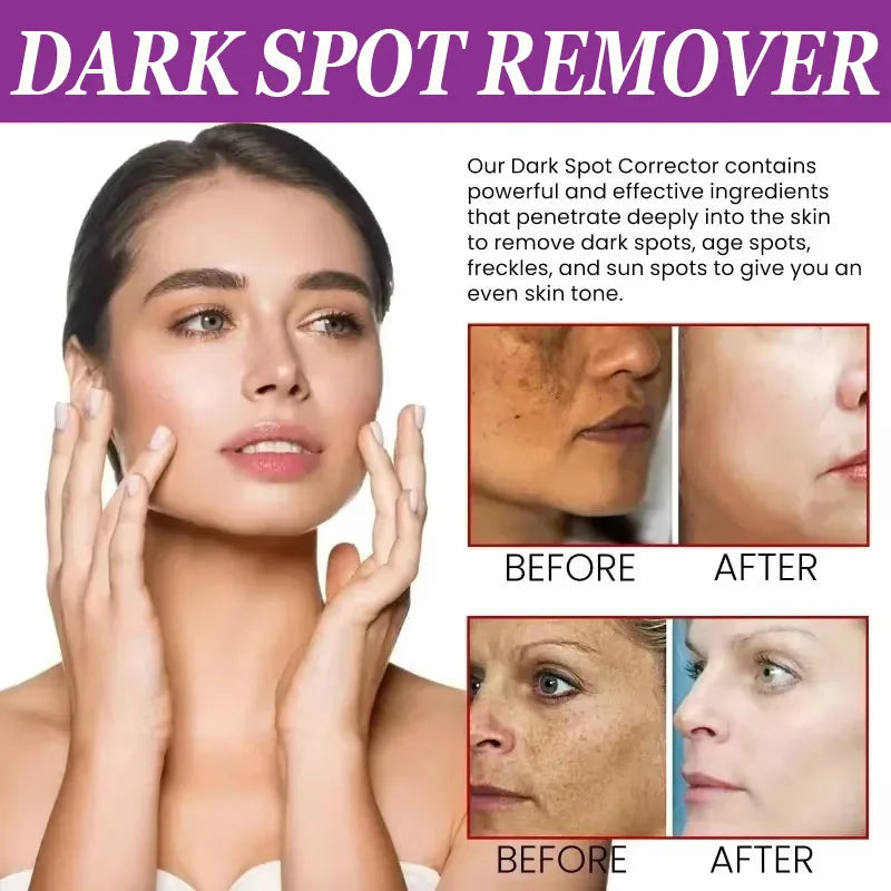 Dark Spots Remover Whitening Serum Face Freckle Melanin Correcting Anti Pigmentation Brighten Beauty Korean Day Night Skin Care