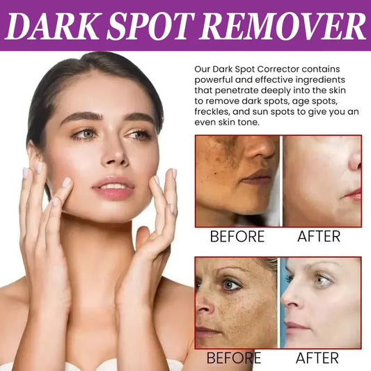 Dark Spots Remover Whitening Serum Face Freckle Melanin Correcting Anti Pigmentation Brighten Beauty Korean Day Night Skin Care
