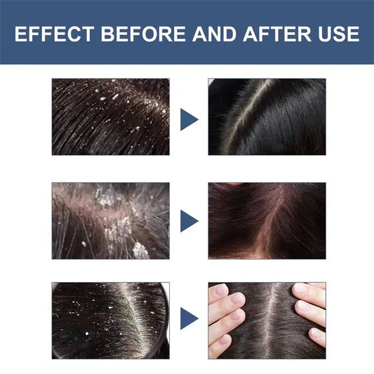 Fast Anti Exfoliating Scrub Remove Dandruff Anti Itching Treatment Seborrheic Scalp Oil Control Cleansing Repair Scalp Care 50g
