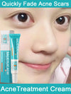 Salicylic Acid Acne Treatment Cream Repair Pimple Spots Deep Cleaning Pore Shrinking Anti-acne Oil Control Moisturizer Skin Care