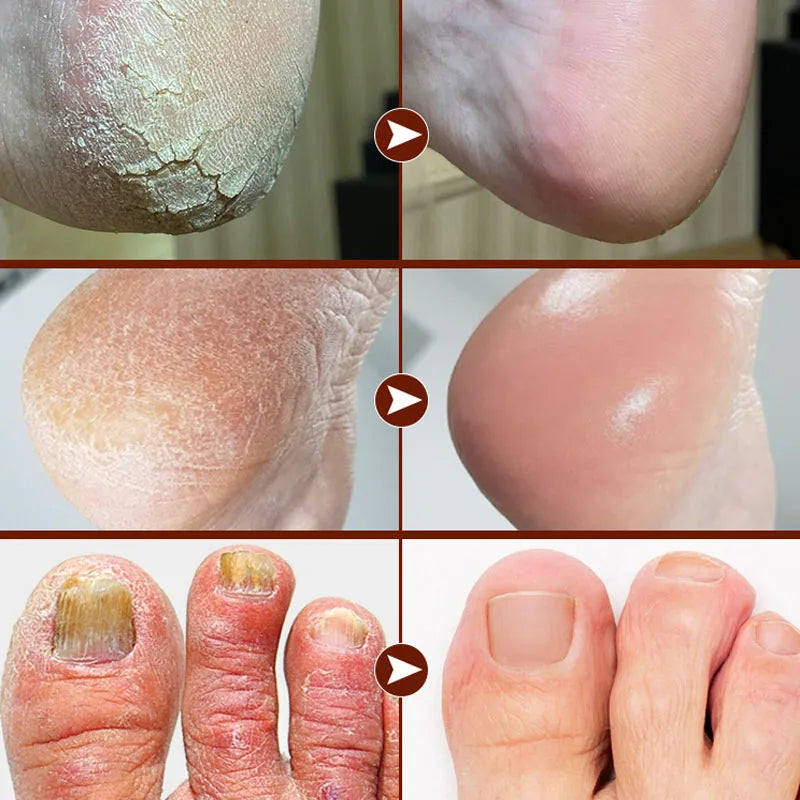 60% Urea Foot Cream Aloe Vera Ultra-hydrating Softening Dry Cracked Feet Cream Gentle Exfoliation Daily Foot Care Solution 40g