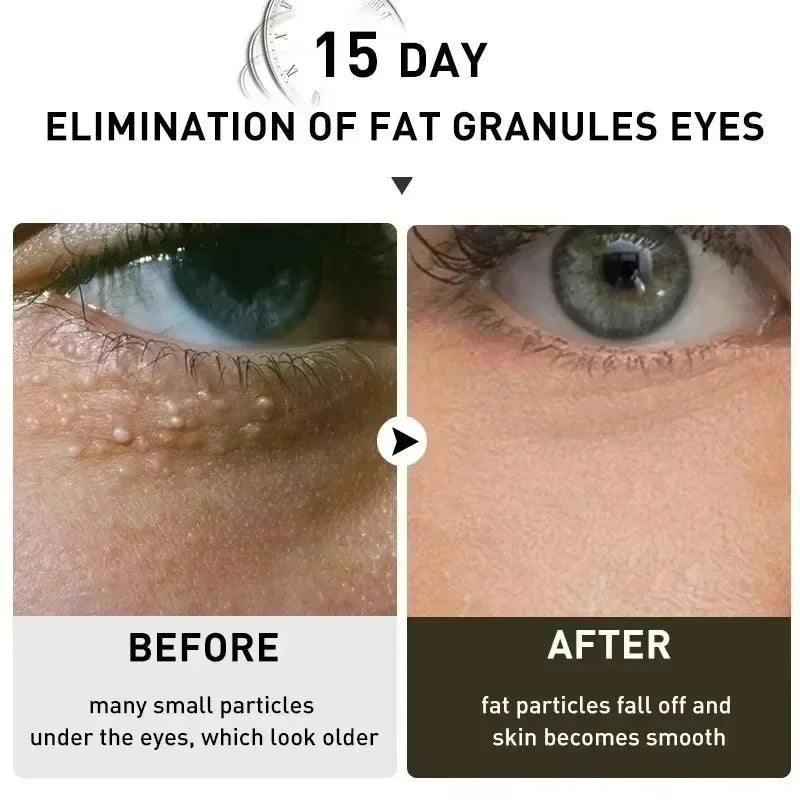 Eye Fat Granules Removal Eyestick Anti-Puffiness Firming Cream Anti Inflammatory Fade Fine Line Repair Skin Barrier Skin Care