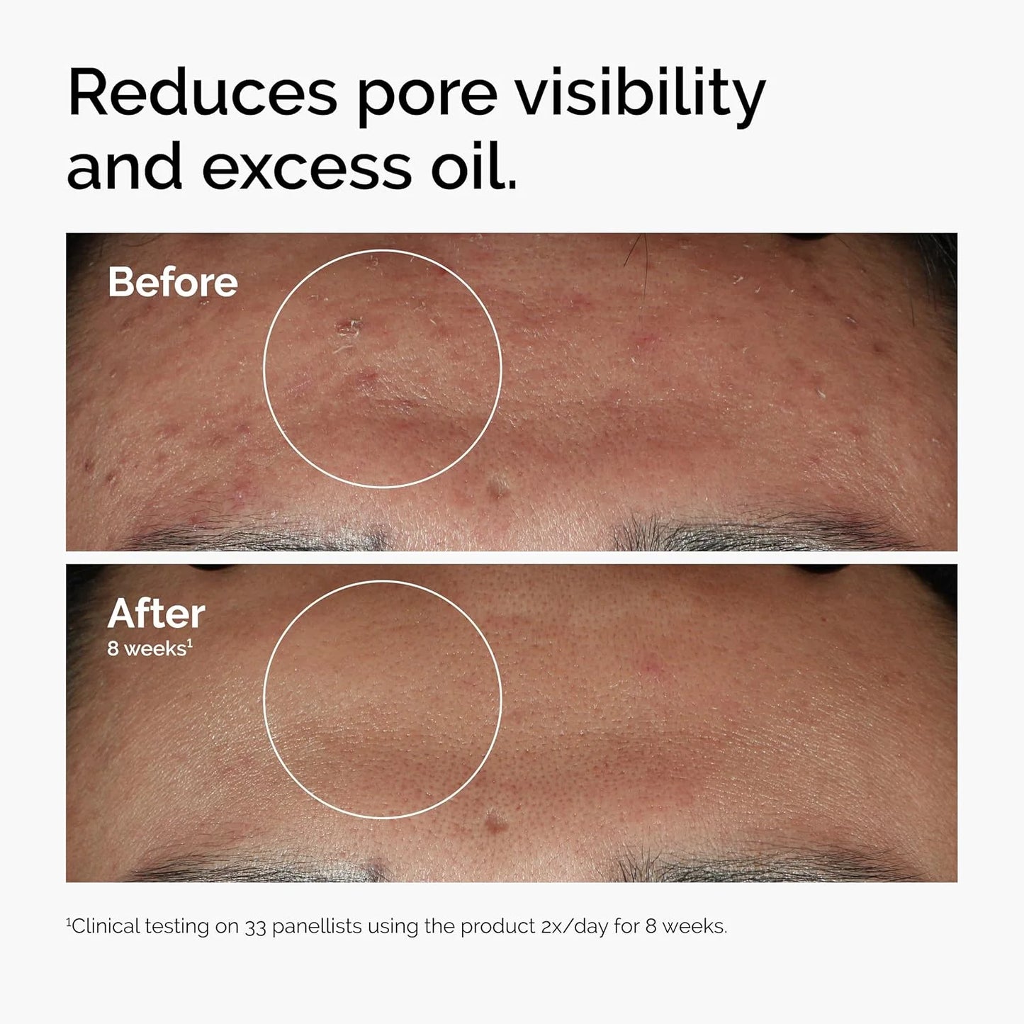 30ml of 10% Niacinamide+1% Zinc, Suitable for Smooth Serum on Skin Prone To Problems, Suitable for Both Men and Women