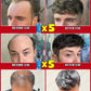 No longer worry about baldness, you will grow thick hair by using this product