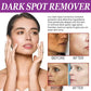 Dark Spots Remover Whitening Serum Face Freckle Melanin Correcting Anti Pigmentation Brighten Beauty Korean Day Night Skin Care