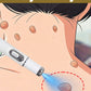 Wart removal pen, skin tag removal pen, suitable for use on the face, neck, hands, and feet.