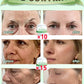 Wrinkles disappear permanently