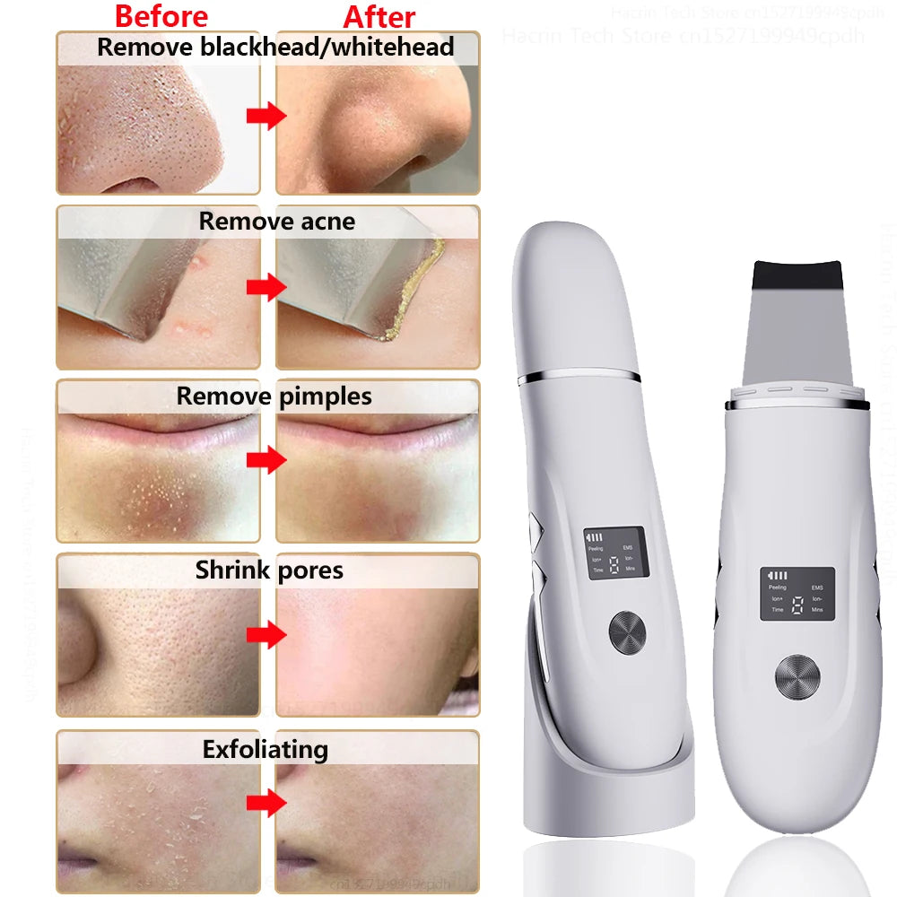 Blackhead Remover Electric Pore Face Cleaner Pimple Acne BlackHead Removal Black Dot Remove Ultrasonic Peeling Remover Blackhead